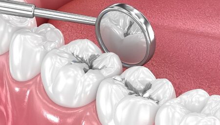 Amalgam Dolgular Değiştirilmeli mi?